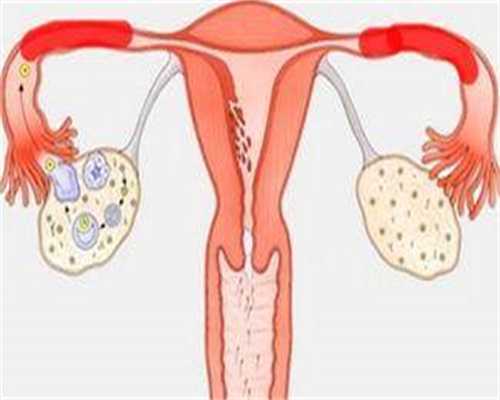 女性健康疑惑：卵巢畸胎瘤，你需要了解的真相